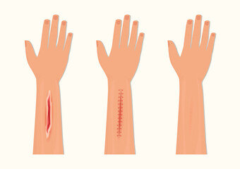 Wound Suturing and Suture Care.