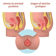 Stages of uterine prolapse. Female reproductive organs diagram and disease infographic. Medical poster. Vector illustration