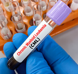 Blood sample for chronic myeloid leukemia (CML) test. It is a rare cancer that affects your bone...