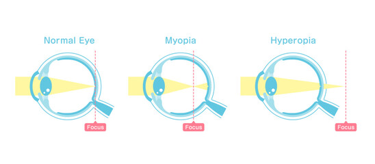 Vector illustration of normal vision and myopia and hyperopia.