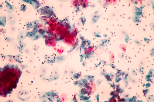 View in microscopic of Candidiasis, fungus infection (Yeast and Pseudohyphae form) in pap smear slide cytology and diagnostic by pathologist.Gynecology report and diagnosis.Sexually transmitted infect