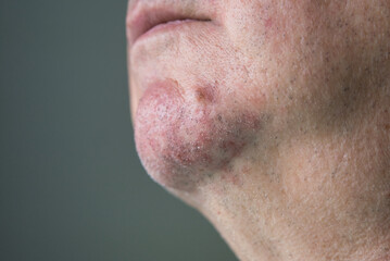 Fototapeta premium A man face chin is having red skin rashes or skin problem