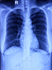 Film x-ray chest PA or CXR (PA view).