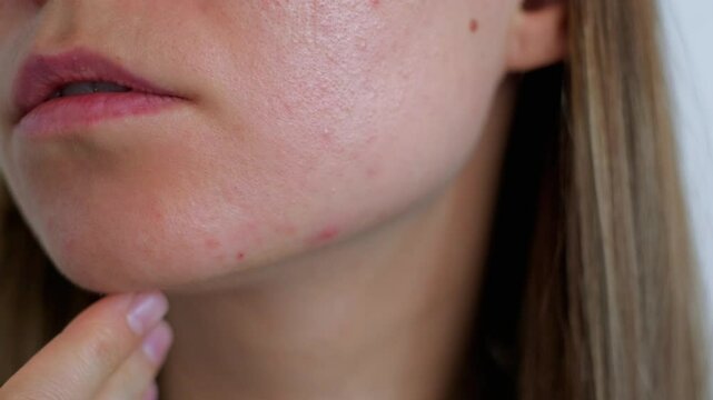 Young girl s face close-up with acne before treatment
