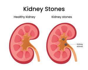 Healthy Kidney and Kidney Stones Vector Illustration