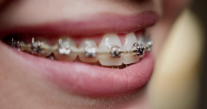 A happy teenager with braces, proudly showing the benefits of orthodontic treatment and good dental care. A cheerful, smiling teenage individual with braces proudly showcasing their teeth in a closeup