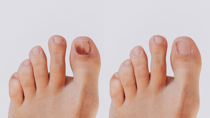 Subcutaneous hematoma. Bruise on the toe nail from tight shoes before and after treatment isolated...