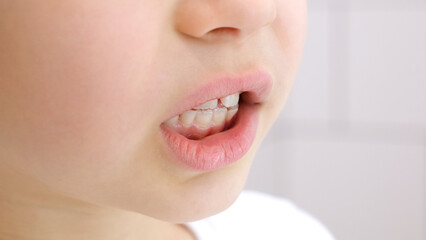 Fototapeta premium The caucasian 6 year child shows his milk and permanent teeth close-up. Has the diastema. The kid performs speech therapy exercises. Gymnastics for the jaw and correct bite. Side view