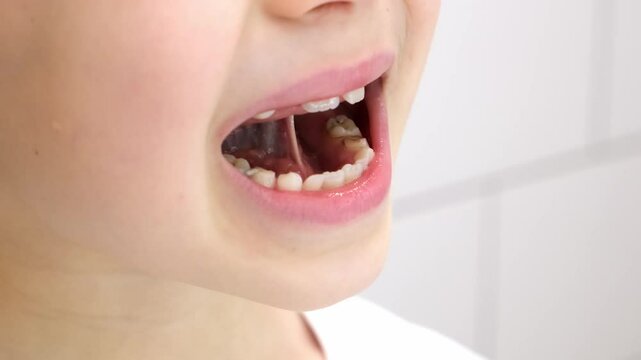 The child opens his mouth and shows the frenulum of the tongue. Classes with a speech therapist. Performing speech therapy exercises. Hygienic examination of the oral cavity. Milk and permanent teeth