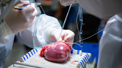 A team of surgeons are practicing artificial heart valve replacement surgery. Sutures are placed through the annulus and through the aortic prosthesis and tied. Concept of medical science and surgery.