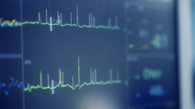 Running curved lines on the screen of medical machine. Equipment working at surgery. Close up.