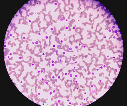 Leukemia. blood cells, blast cells, and immature leukocytic cells in chronic lymphocytic leukemia, and prolymphocytic leukemia. Analyze by microscope.