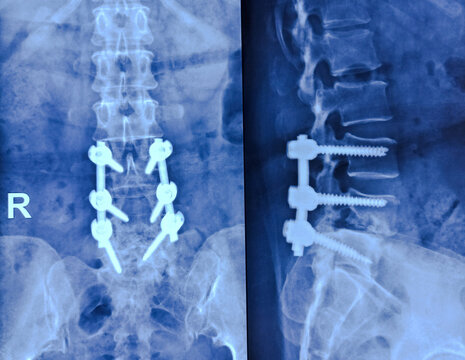 X-ray of the lumbosacral spine. Lumbar spondylosis with grade 1 spondylolisthesis of L4 over L5. Sacralization of L5 vertebra on the left side. Metallic fixators (plate and screw) were noted in L3-L5 