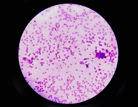 Leukemia. blood cells, blast cells, and immature leukocytic cells in chronic lymphocytic leukemia, and prolymphocytic leukemia. Analyze by microscope.
