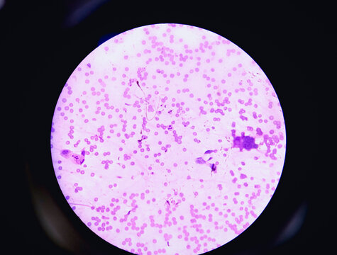 Leukemia. blood cells, blast cells, and immature leukocytic cells in chronic lymphocytic leukemia, and prolymphocytic leukemia. Analyze by microscope.