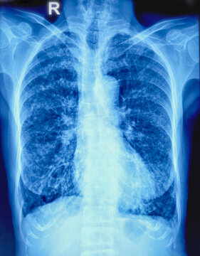 X-ray of the human chest. Bilateral extensive pulmonary inflammatory change having scattered fibrosis, reticulations. CT scan of chest recommended for further evaluation. 
