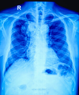 X-ray of the human chest. Sternotomy sutures noted in situ. Suggestive of right supra-hilar mass lesion (? bronchogenic growth or lymphadenopathy). 