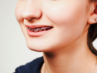 Teenager girl showing her expensive and stylish modern pink color braces. Light background. Selective focus. Dental job on improving appearance. High cost procedure. Health and beauty concept.