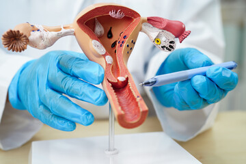 Uterus, doctor holding human anatomy model for study diagnosis and treatment in hospital.