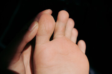 Fototapeta premium Dry and cracked heels foot. Unhealthy skin from weather which need moisturizer