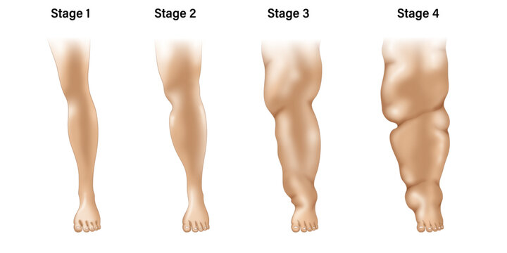 Stages of Lymphedema Medical Illustration, Disease Progression Visualization