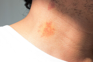 Photographs of a person with bruises on the neck (hickey). 
