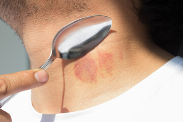 Picture of spoon healing a hickey on a person's neck.