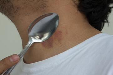 Picture of spoon healing a hickey on a person's neck.