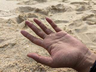 Skin peeling on the palms of young female hands