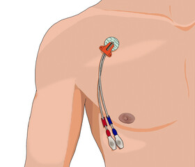 Central venous catheter