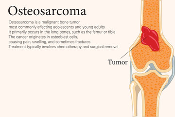 Split bone revealing an osteosarcoma tumor inside, highlighting malignant growth and bone pathology. with  description text. eps 10