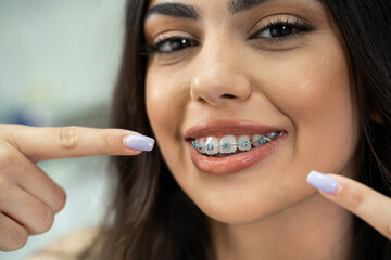 Extreme closeup of young woman with dental braces, pointing towards her mount 