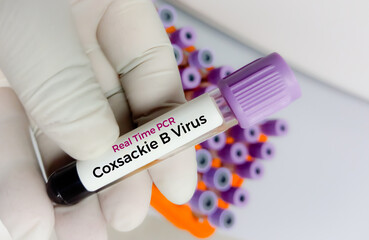 Blood sample for Hand foot and mouth disease (HFMD) test. It is a highly contagious infection. It's...