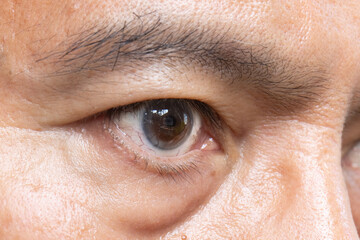 Senior man eye strain after for long stretches at computer or digital screens.