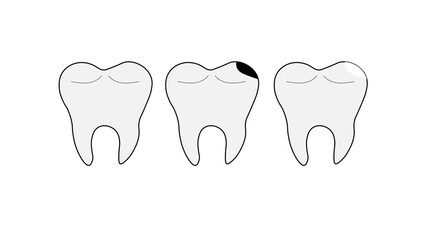 three teeth set of healthy caries and with a filling on a white background