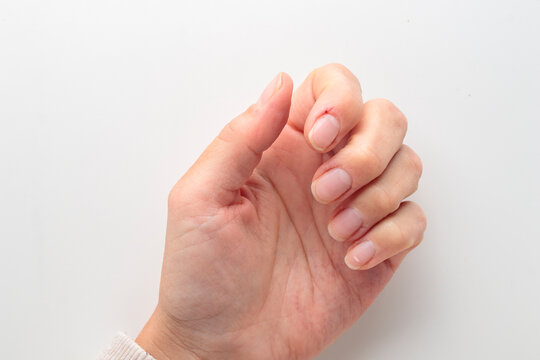 Closeup of hand with deformed nails and torn, ripped and picked on cuticle skin peeling off from human nail biting behavior