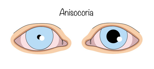 Anisocoria