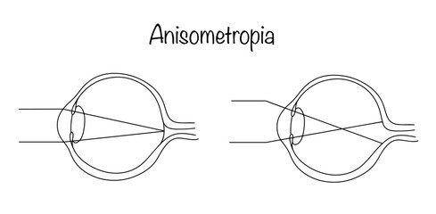 Anisometropia