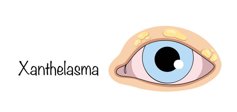 Xanthelasma