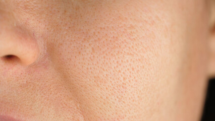 Close-up of facial skin with enlarged pores. close-up of a woman face. problem skin treatment...