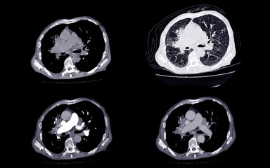 Obraz premium A CT scan of the chest showing multiple cross-sectional views, highlighting the lungs, heart, and major vessels, used for medical analysis of thoracic structures.