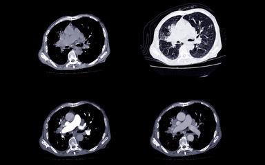 Obraz premium A CT scan of the chest showing multiple cross-sectional views, highlighting the lungs, heart, and major vessels, used for medical analysis of thoracic structures.