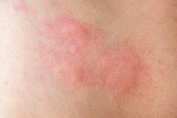 Skin allergy rash dermatitis texture close up background