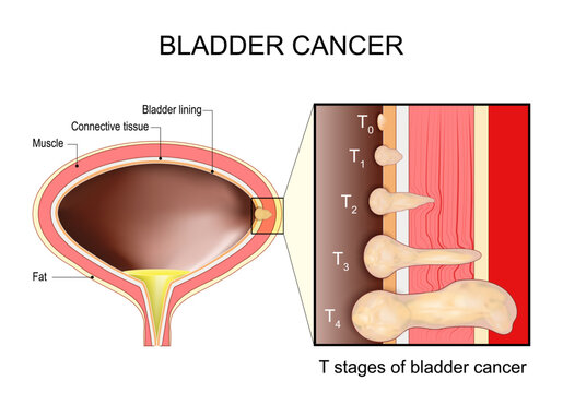 Bladder cancer Stages