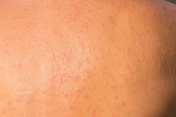 Sun allergy. Close-up of a man's back with an allergic reaction to the sun. The red tanned back shows many pimples and rashes. Dermatology and sun protection concept.