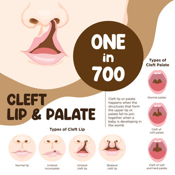 Vector illustration of cleft lip and palate diagram poster