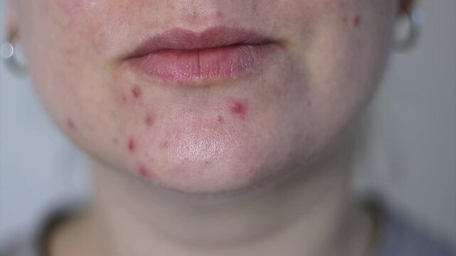 Close up of female face with red problematic acne skin