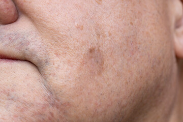 Result after two weeks of cryotherapy on Seborrheic Keratosis (Seborrhoeic wart, Basal cell papilloma, Senile wart) Skin Growth on man's cheek