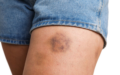 Woman with bruise on leg against white background, closeup