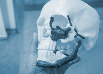 Man holding in hand proto-human skull from white plastic with titanium implants in form of plates and surgical templates printed on 3D printer. Biointegrated prosthesis